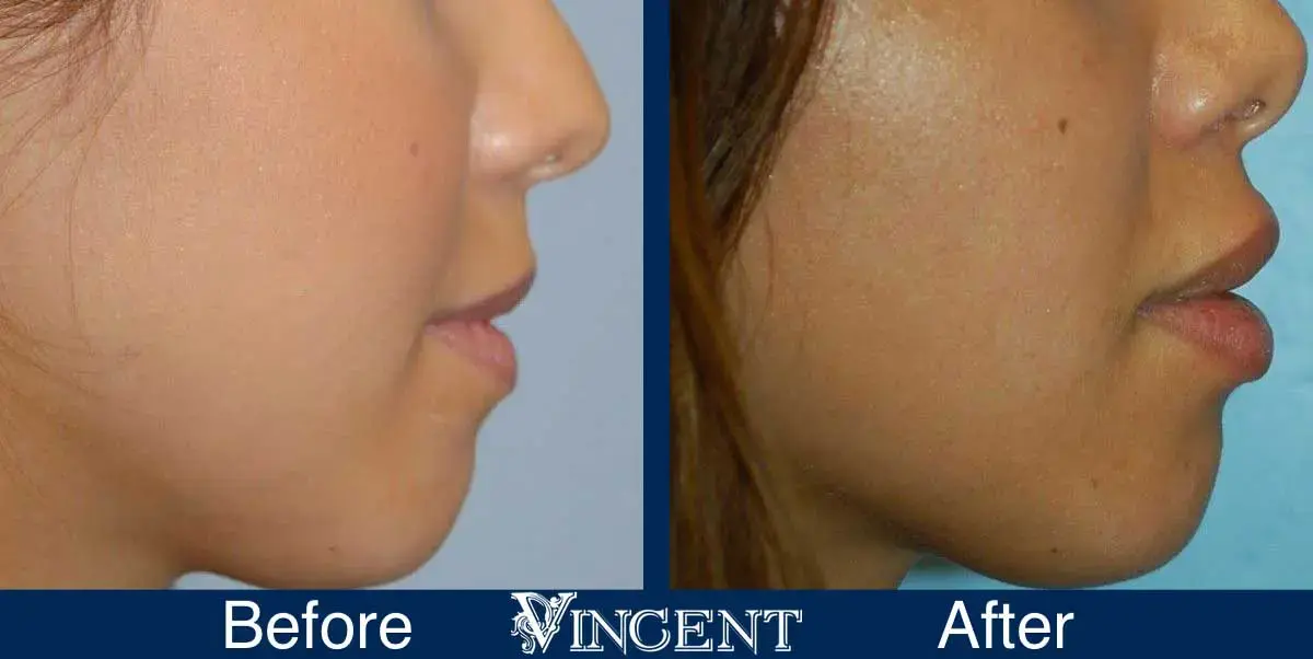 Vincent Surgical Arts lip filler result — Cottonwood Heights, UT