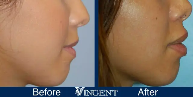 Lip Filler result at Vincent Surgical Arts in Cottonwood Heights, UT