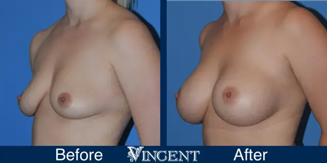 Breast Augmentation result at Vincent Surgical Arts in Cottonwood Heights, UT