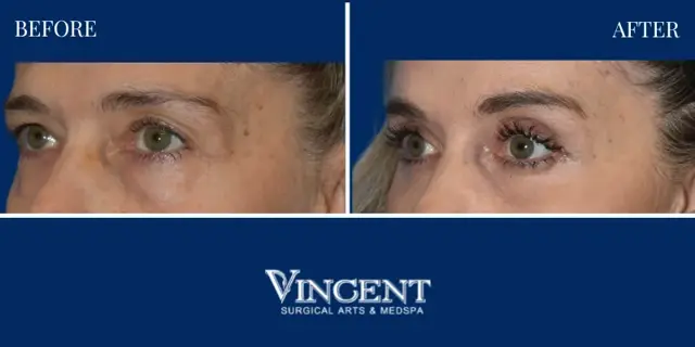 Blepharoplasty result at Vincent Surgical Arts in Cottonwood Heights, UT