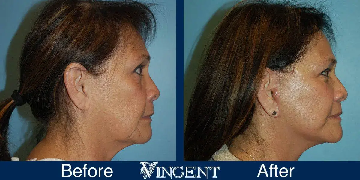 Vincent Surgical Arts facelift result — Cottonwood Heights, UT