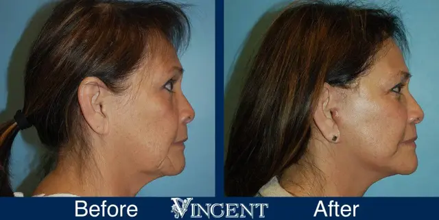 Facelift result at Vincent Surgical Arts in Cottonwood Heights, UT