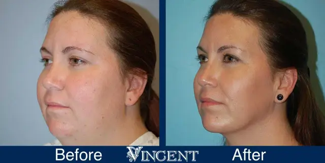 Liposuction result at Vincent Surgical Arts in Cottonwood Heights, UT
