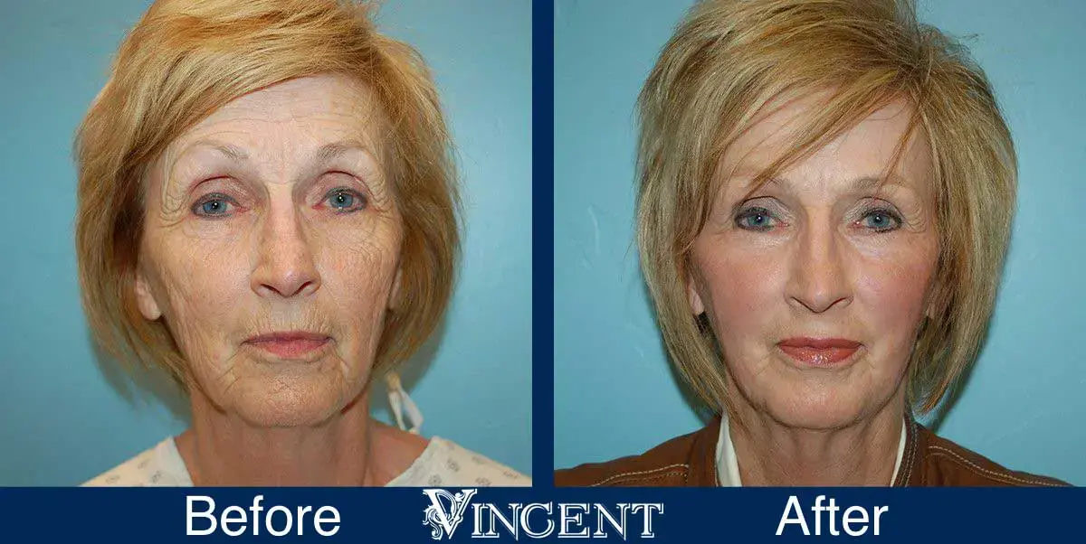 Vincent Surgical Arts fat transfer result — Cottonwood Heights, UT