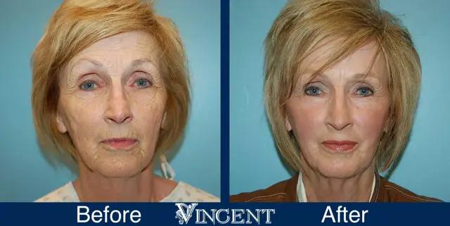 Fat Transfer result at Vincent Surgical Arts in Cottonwood Heights, UT