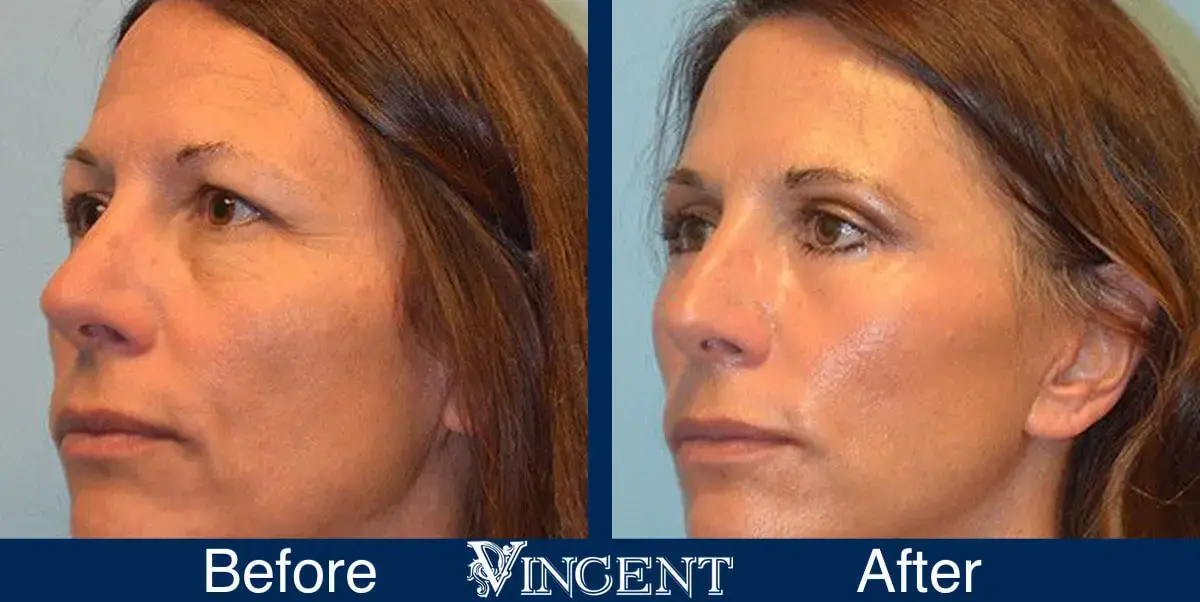 Vincent Surgical Arts blepharoplasty result — Cottonwood Heights, UT
