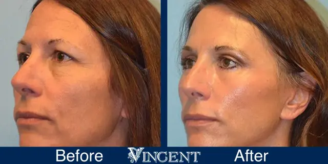 Blepharoplasty result at Vincent Surgical Arts in Cottonwood Heights, UT