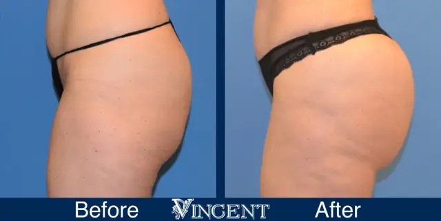 Brazilian Butt Lift result at Vincent Surgical Arts in Cottonwood Heights, UT