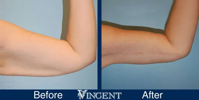 Arm Lift result at Vincent Surgical Arts in Cottonwood Heights, UT