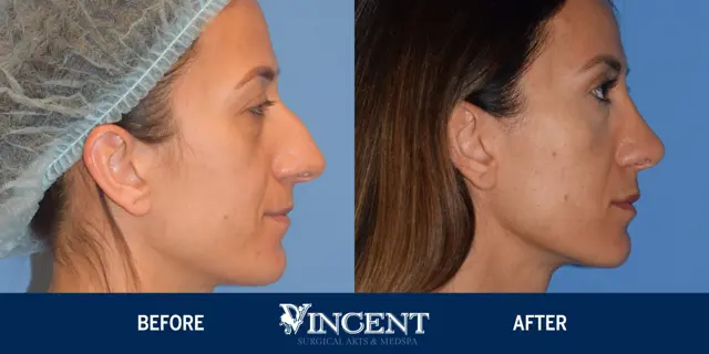 Rhinoplasty result at Vincent Surgical Arts in Cottonwood Heights, UT