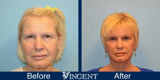 Blepharoplasty result at Vincent Surgical Arts in Cottonwood Heights, UT