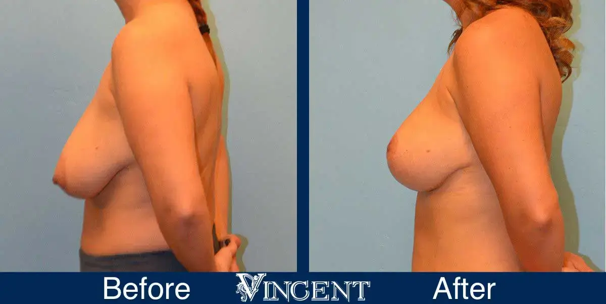 Vincent Surgical Arts breast reduction result — Cottonwood Heights, UT