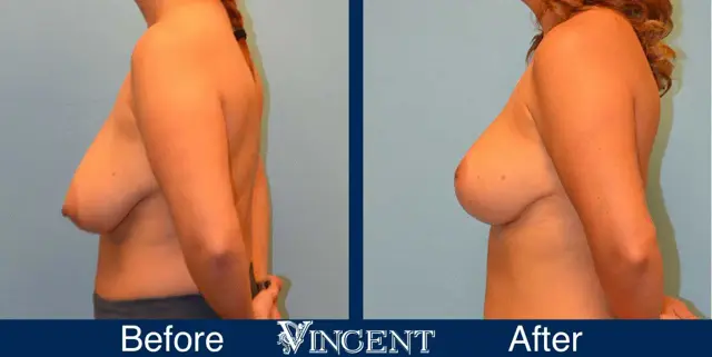 Breast Reduction result at Vincent Surgical Arts in Cottonwood Heights, UT