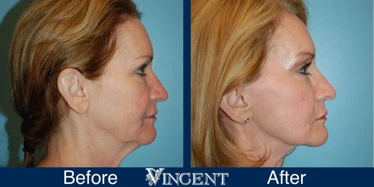 Vincent Surgical Arts facelift result — Cottonwood Heights, UT