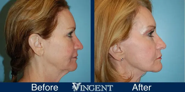 Facelift result at Vincent Surgical Arts in Cottonwood Heights, UT