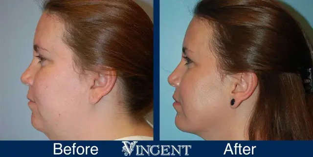 Neck Liposuction result at Vincent Surgical Arts in Cottonwood Heights, UT