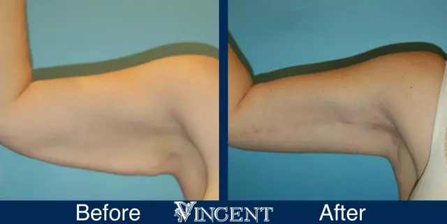 Arm Lift result at Vincent Surgical Arts in Cottonwood Heights, UT