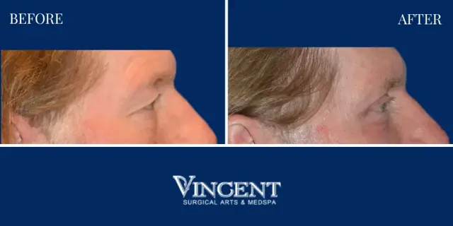 Blepharoplasty result at Vincent Surgical Arts in Cottonwood Heights, UT