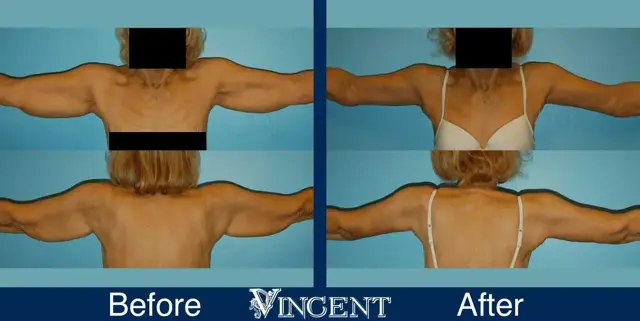 Arm Lift result at Vincent Surgical Arts in Cottonwood Heights, UT