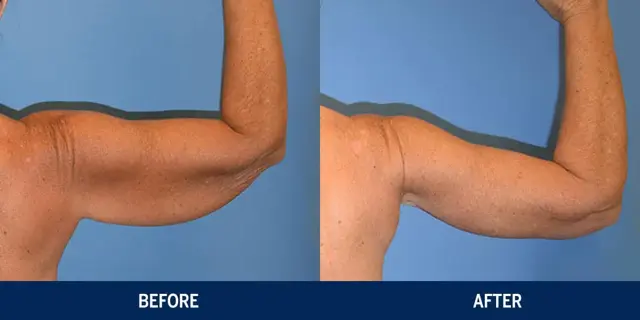 Arm Lift result at Vincent Surgical Arts in Cottonwood Heights, UT