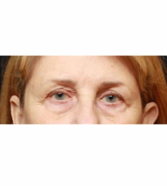 Blepharoplasty before at Moy, Fincher, Chipps Facial Plastics & Dermatology - Beverly Hills in Beverly Hills, CA