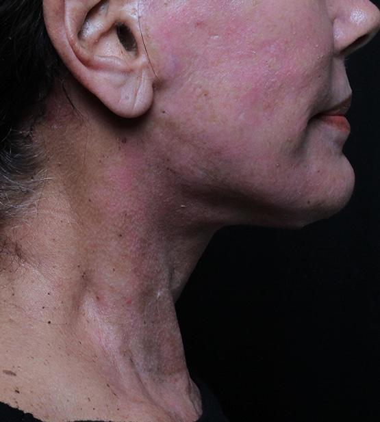 Neck Lift after at Moy, Fincher, Chipps Facial Plastics & Dermatology - Beverly Hills in Beverly Hills, CA