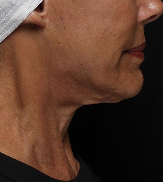 Neck Lift before at Moy, Fincher, Chipps Facial Plastics & Dermatology - Beverly Hills in Beverly Hills, CA