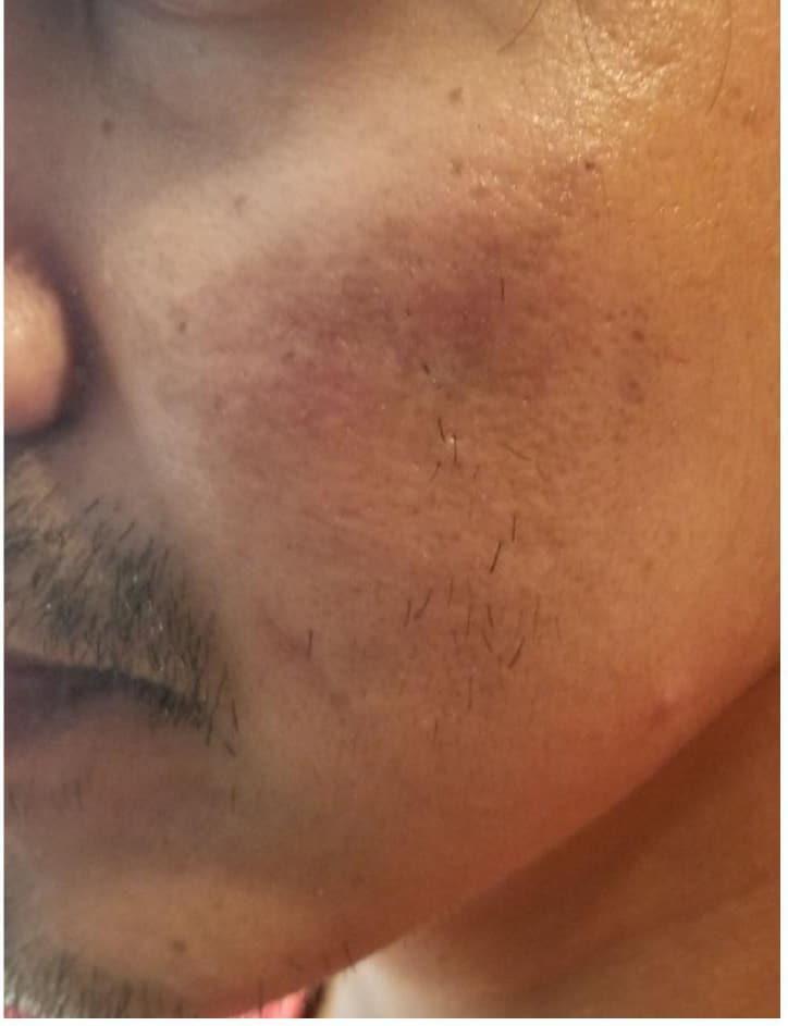 Moy, Fincher, Chipps Facial Plastics & Dermatology - Beverly Hills microneedling after — Beverly Hills, CA