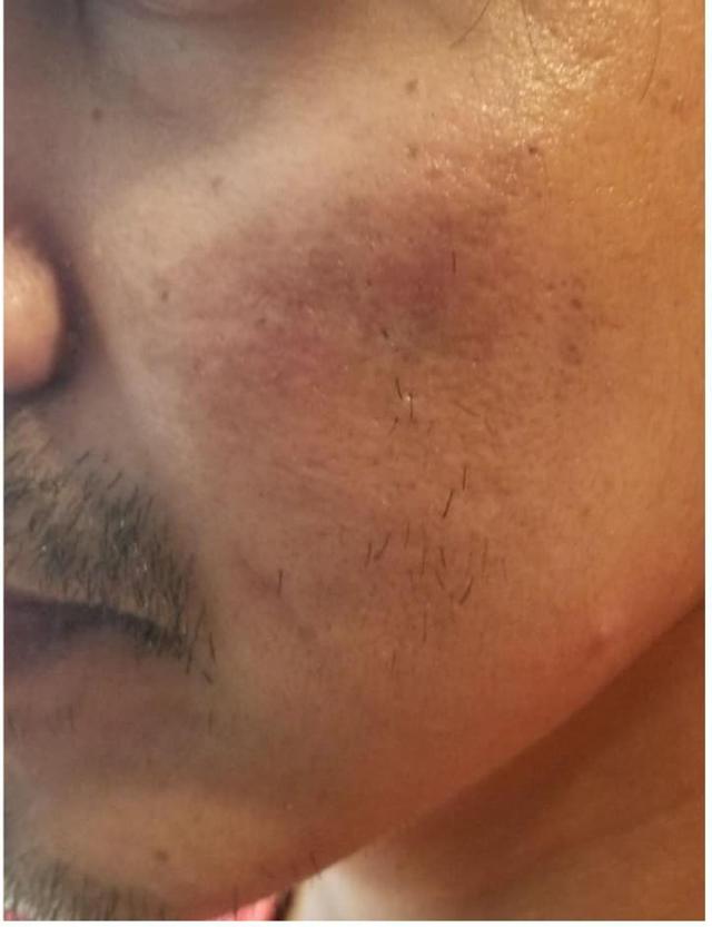 Microneedling after at Moy, Fincher, Chipps Facial Plastics & Dermatology - Beverly Hills in Beverly Hills, CA