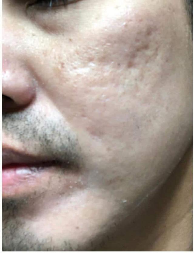 Microneedling before at Moy, Fincher, Chipps Facial Plastics & Dermatology - Beverly Hills in Beverly Hills, CA