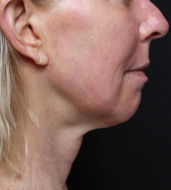 Neck Lift after at Moy, Fincher, Chipps Facial Plastics & Dermatology - Beverly Hills in Beverly Hills, CA