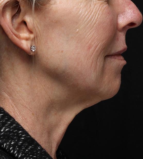 Neck Lift before at Moy, Fincher, Chipps Facial Plastics & Dermatology - Beverly Hills in Beverly Hills, CA