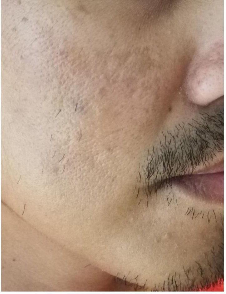 Moy, Fincher, Chipps Facial Plastics & Dermatology - Beverly Hills microneedling after — Beverly Hills, CA