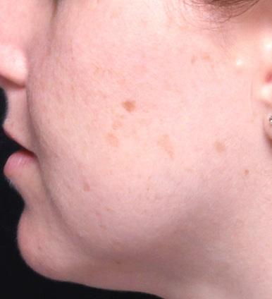 Breast Augmentation before at Moy, Fincher, Chipps Facial Plastics & Dermatology - Beverly Hills in Beverly Hills, CA