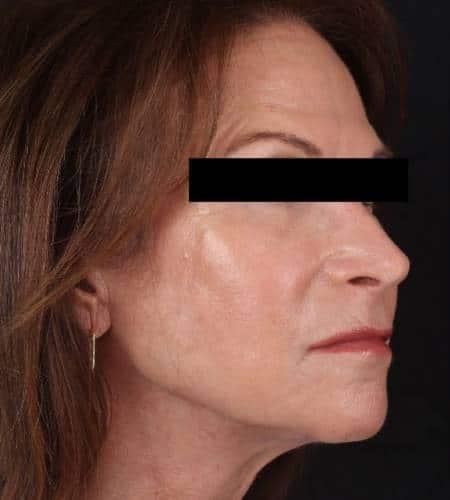 Facelift after at Moy, Fincher, Chipps Facial Plastics & Dermatology - Beverly Hills in Beverly Hills, CA