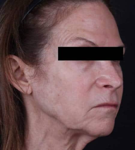 Facelift before at Moy, Fincher, Chipps Facial Plastics & Dermatology - Beverly Hills in Beverly Hills, CA