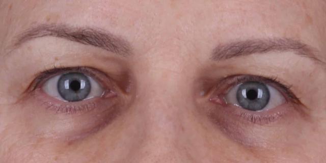 Fat Transfer before at Moy, Fincher, Chipps Facial Plastics & Dermatology - Beverly Hills in Beverly Hills, CA