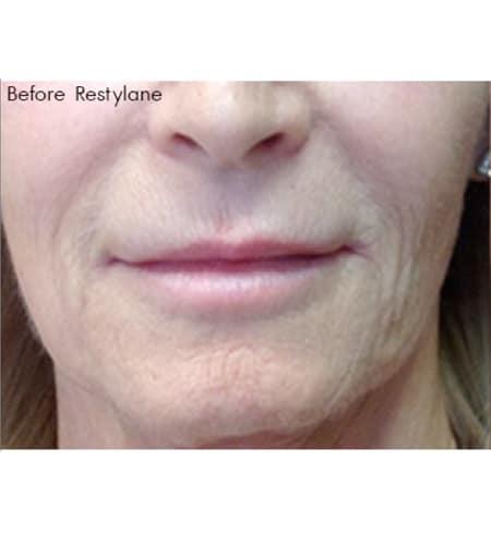 Lip Filler before at Moy, Fincher, Chipps Facial Plastics & Dermatology - Beverly Hills in Beverly Hills, CA