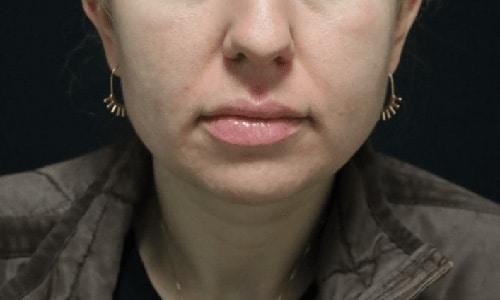 Moy, Fincher, Chipps Facial Plastics & Dermatology - Beverly Hills after — Beverly Hills, CA