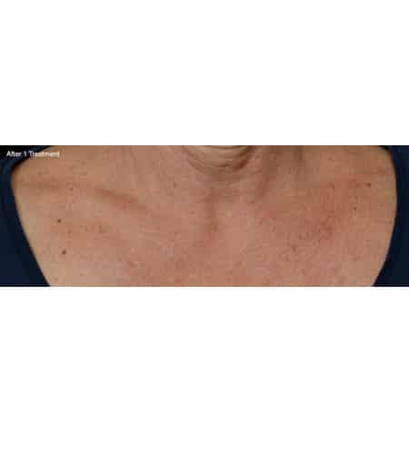 Laser Skin Resurfacing after at Moy, Fincher, Chipps Facial Plastics & Dermatology - Beverly Hills in Beverly Hills, CA