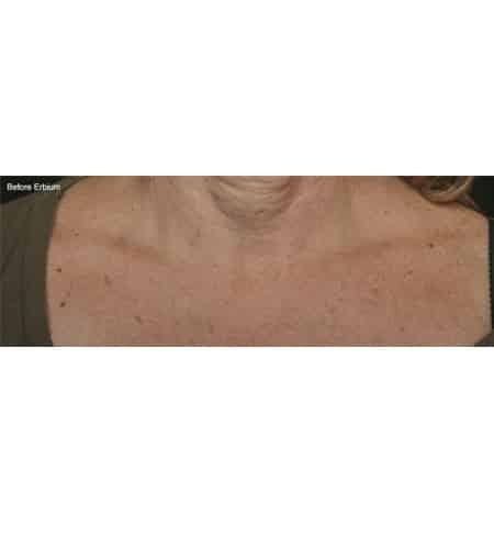 Laser Skin Resurfacing before at Moy, Fincher, Chipps Facial Plastics & Dermatology - Beverly Hills in Beverly Hills, CA