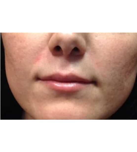 Lip Filler after at Moy, Fincher, Chipps Facial Plastics & Dermatology - Beverly Hills in Beverly Hills, CA