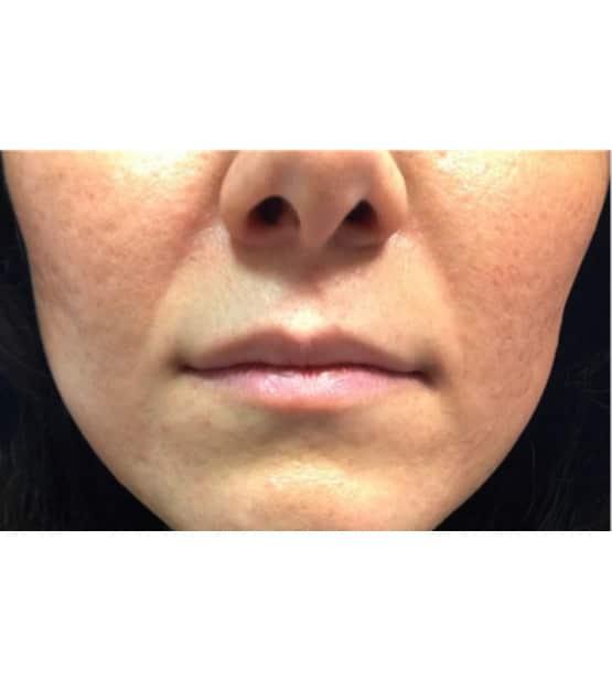 Lip Filler before at Moy, Fincher, Chipps Facial Plastics & Dermatology - Beverly Hills in Beverly Hills, CA