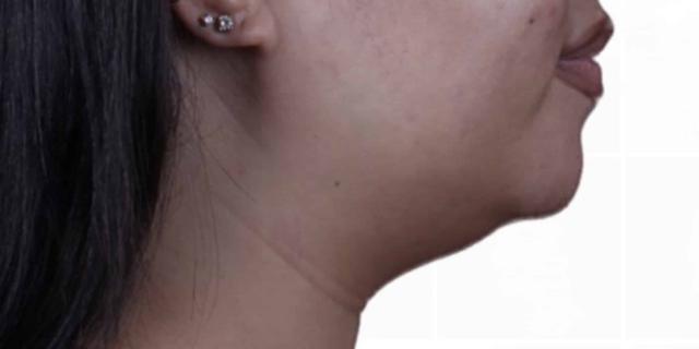 Liposuction before at Moy, Fincher, Chipps Facial Plastics & Dermatology - Beverly Hills in Beverly Hills, CA