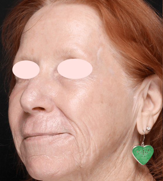 Moy, Fincher, Chipps Facial Plastics & Dermatology - Beverly Hills laser treatment after — Beverly Hills, CA