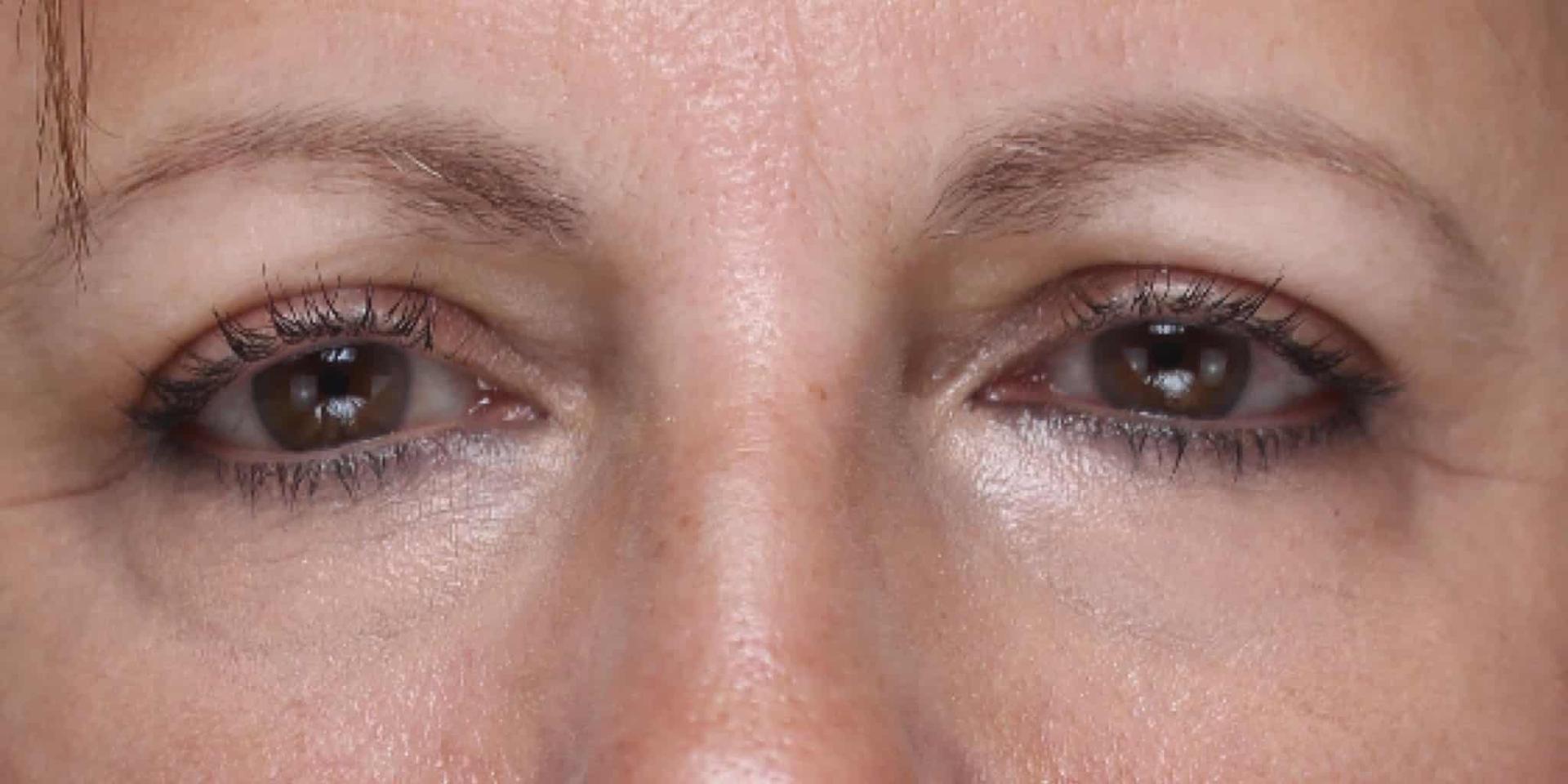 Moy, Fincher, Chipps Facial Plastics & Dermatology - Beverly Hills laser treatment after — Beverly Hills, CA