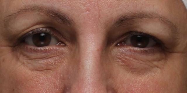 Laser Skin Resurfacing before at Moy, Fincher, Chipps Facial Plastics & Dermatology - Beverly Hills in Beverly Hills, CA