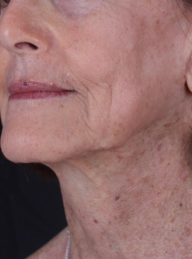 Neck Lift after at Moy, Fincher, Chipps Facial Plastics & Dermatology - Beverly Hills in Beverly Hills, CA