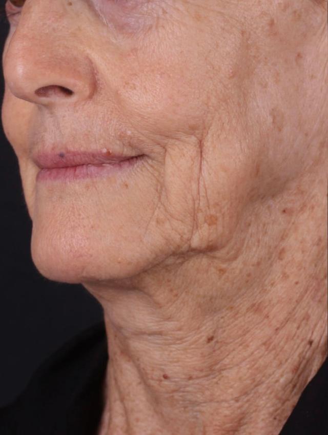 Neck Lift before at Moy, Fincher, Chipps Facial Plastics & Dermatology - Beverly Hills in Beverly Hills, CA