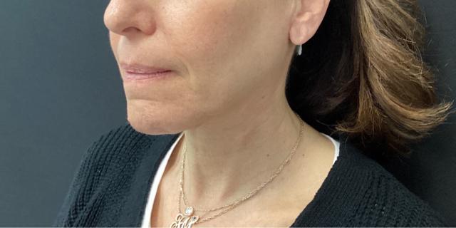 Neck Lift after at Moy, Fincher, Chipps Facial Plastics & Dermatology - Beverly Hills in Beverly Hills, CA